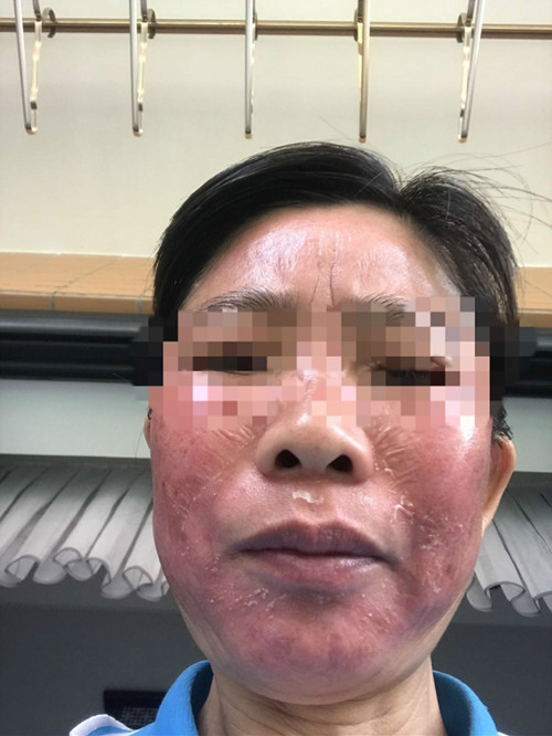 受害者被诊断为严重过敏致接触性皮炎